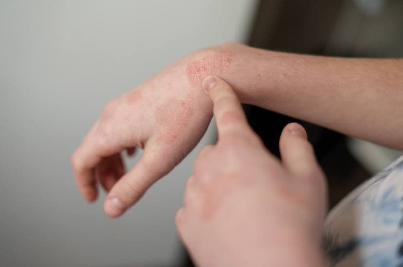 Атопичен дерматит